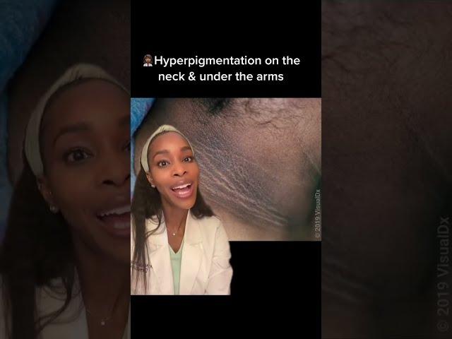 How to get rid of hyperpigmentation on the neck and under the arms