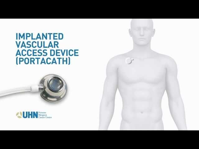 Port-a-Cath (Implanted Vascular Access Device)