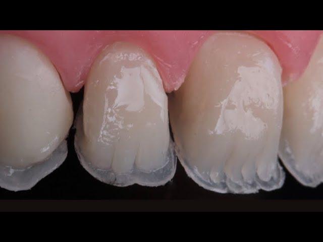 Guided anterior composite restoration using silicon index with fantastic 4