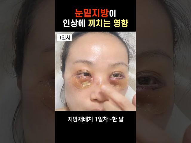 눈밑지방이 인상에 끼치는 영향 | 한달 후 #눈밑지 #눈밑지방재배치 #눈밑지방재배치후기 #지방재배치붓기 #눈밑지방재배치회복과정 #모즈클리닉