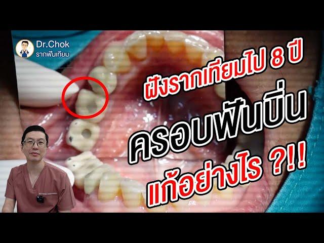 ฝังรากฟันเทียมไป 8 ปี จนครอบฟันบิ่น แก้อย่างไร คลิปนี้มีคำตอบ ?!!  | คลายปัญหารากฟันเทียมกับหมอโชค