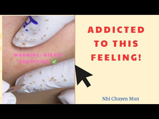 𝐑𝐞𝐬𝐜𝐮𝐞 𝐘𝐨𝐮𝐫 𝐒𝐤𝐢𝐧: 𝐀 𝐏𝐫𝐨𝐟𝐞𝐬𝐬𝐢𝐨𝐧𝐚𝐥 𝐃𝐞𝐞𝐩 𝐏𝐨𝐫𝐞𝐄𝐱𝐭𝐫𝐚𝐜𝐭𝐢𝐨𝐧 - 𝐂𝐥𝐞𝐚𝐧 𝐭𝐨 𝐭𝐡𝐞 𝐋𝐚𝐬𝐭 𝐌𝐢𝐥𝐥𝐢𝐦𝐞𝐭𝐞𝐫!