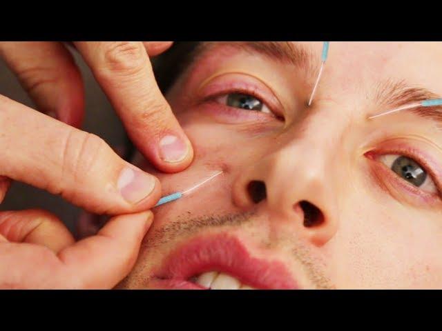 The Try Guys Try Acupuncture