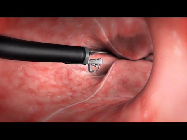 What Happens During the Endoscopic Sleeve Gastroplasty (ESG) Procedure?