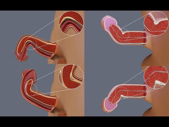 Why Peyronie's Disease Causes Penile Curvature in Different Directions