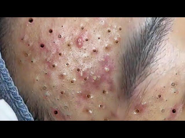 Relax Skincare Everyday with Acne Blackheads Treatment Spa #91014