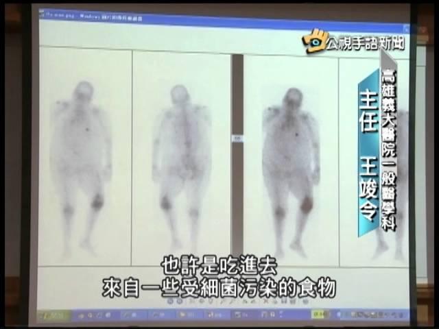 20140505 公視手語新聞 大腸桿菌高抗藥 入侵人體關節奪命