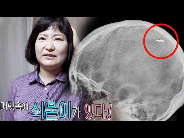 내 머릿속에 ‘쇠붙이’ 미스터리 주인공!   @순간포착 세상에 이런 일이 1031회 20190425