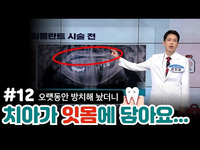 12편) 치아 없이 그냥 생활하고 있어요...40대 여성의 임플란트 치료