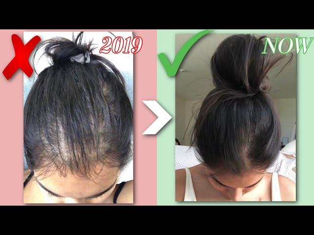 HOW I GREW MY HAIR BACK NATURALLY | Q&A, BEFORE & AFTERS, HAIR LOSS STORY | RESULTS IN JUST 1 MONTH