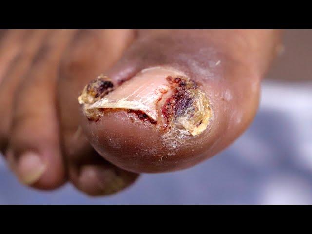 Ever Seen a JUICY INFECTED INGROWN TOENAIL Before???