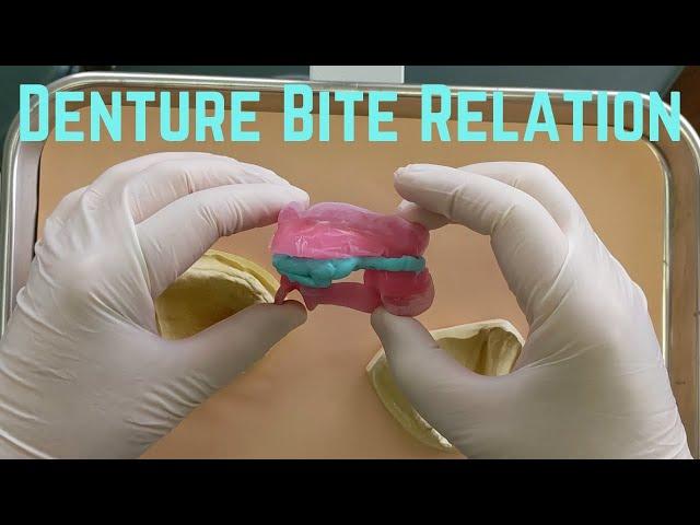 Bite Registration for a denture