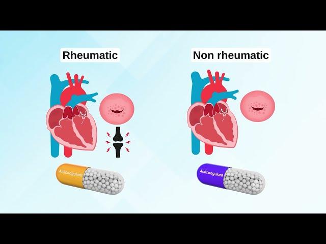 Atrial fibrillation