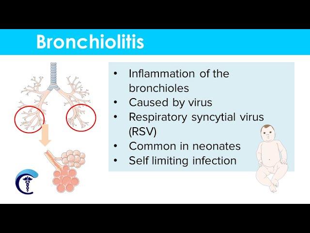 Bronchiolitis: Causes, Classification, Symptoms, Diagnosis and Treatment