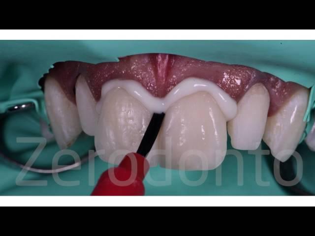 Dental Veneers