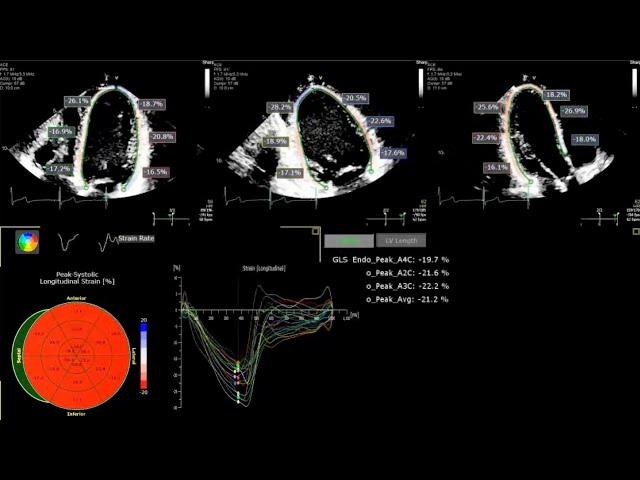 A Practical Guide to Echocardiographic Global Longitudinal Strain (GLS) by 2D Speckle Tracking