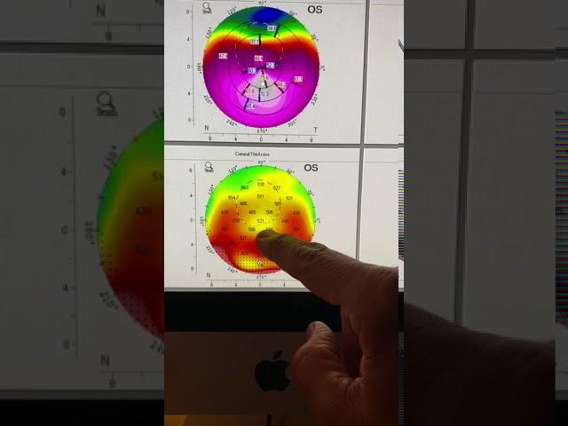 Pellucid marginal degeneration vs. Keratoconus diagnosis Kanellopoulos MD