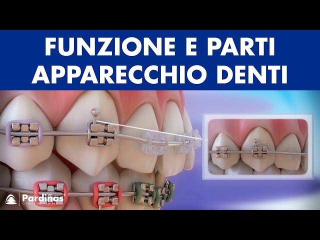 Ortodonzia - Funzione e parti apparecchio denti ©