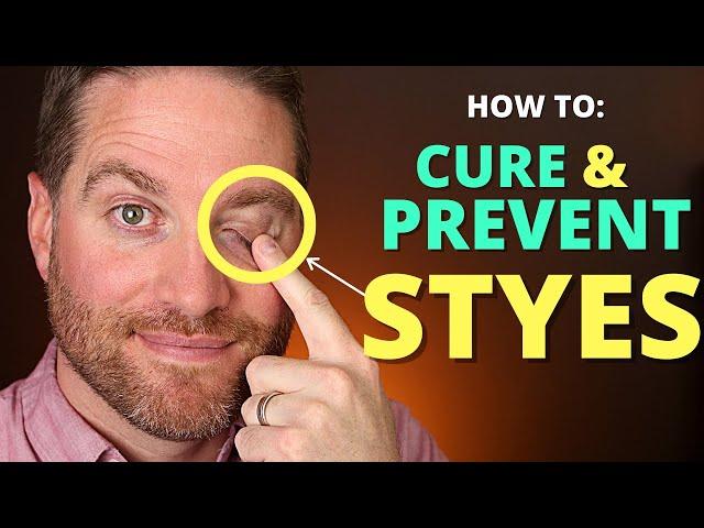 How To CURE And PREVENT STYES: Get Rid Of A Hordeolum (stye) And Chalazion Fast!