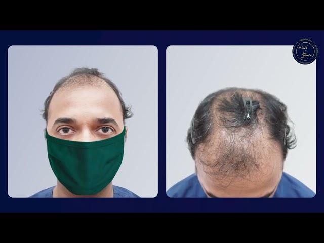 Hair Transplant in Mumbai | Best Results & Cost of Hair Transplant in Mumbai | Dr. Umang Kothari.