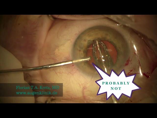 Dr. Florian Kretz: ZEPTO® Capsulotomy without OVD