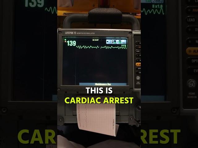 Ventricular Tachycardia to Fibrillation