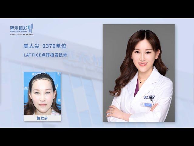 深圳雍禾植髮效果怎麼樣？雍禾護士都在給自己植髮！Yonghe hair transplant