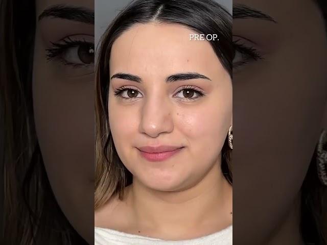 Face Surgery: Modern Techniques, Recovery Realities & Achieving Natural Results
