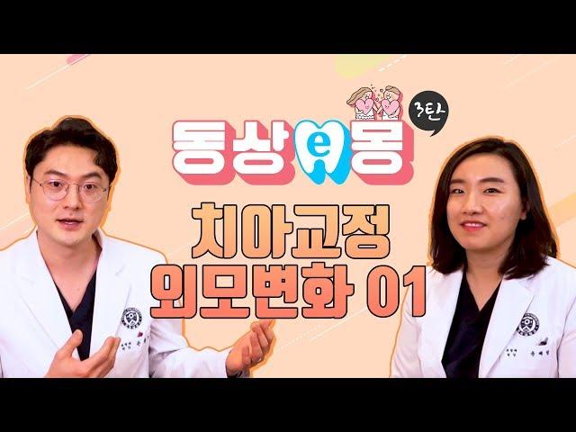 치아교정하면 예뻐질까? 교정과 의사가 말하는 치아교정 외모변화 1편