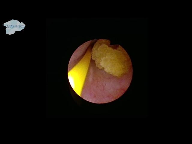 Localization of the ureter stone