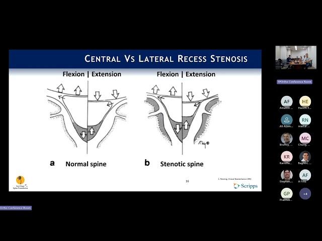 Indications: Neurogenic Claudication & Lateral Recess Stenosis : Phil Fagan, MD