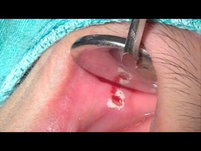 Er:YAG Laser Oral Ulcer Treatment