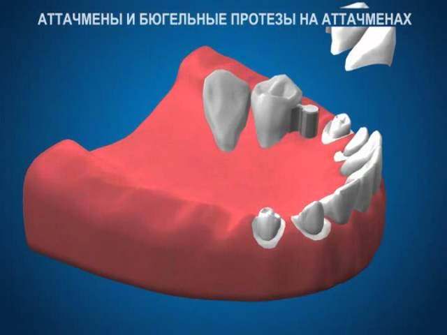 Ортопедическая стоматология - Аттачмены и бюгельные протезы на аттачменах - Доктор Стом