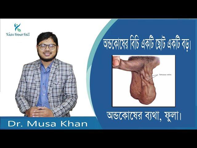 অন্ডকোষে ব্যাথা, রগ ফুলা। অন্ডকোষের বিচি একটা ছোট বড়। ১০০% কার্যকরী চিকিৎসা