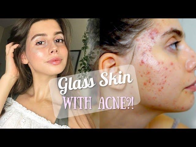 TRYING TO ACHIEVE GLASS SKIN WITH ACNE!! || Using Tarte, Physicians Formula, Morphe