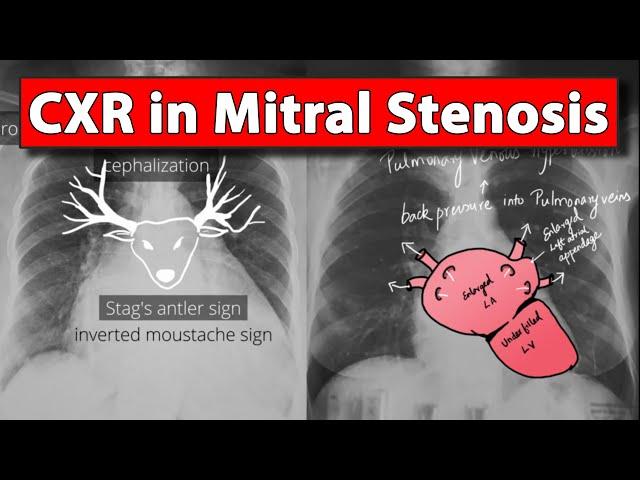 Chest X-ray (Part 3)  in Mitral Stenosis | Made easy