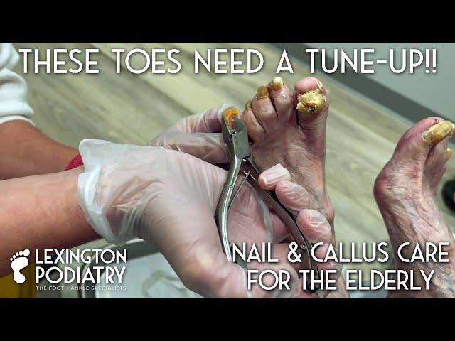 These Toes Need A Tune-up!! Nail & Callus Care for the Elderly