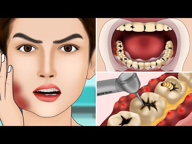 ASMR Molar Tooth Caries Removal so Satisfying part3 | Dental Care Animation | 어금니 우식증 제거 너무 만족