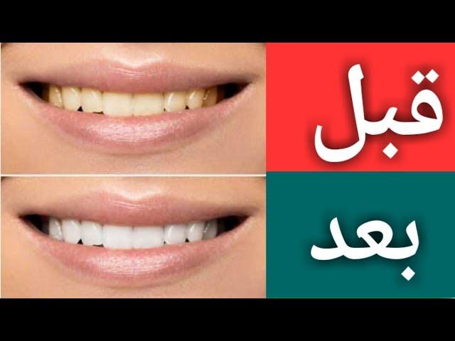 سفید کردن دندانها به روش بسیار ساده و آسان