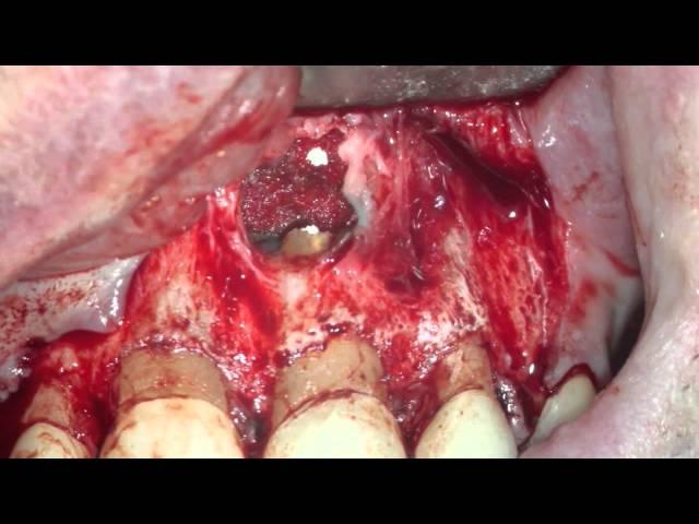 Anterior Periapical Surgery