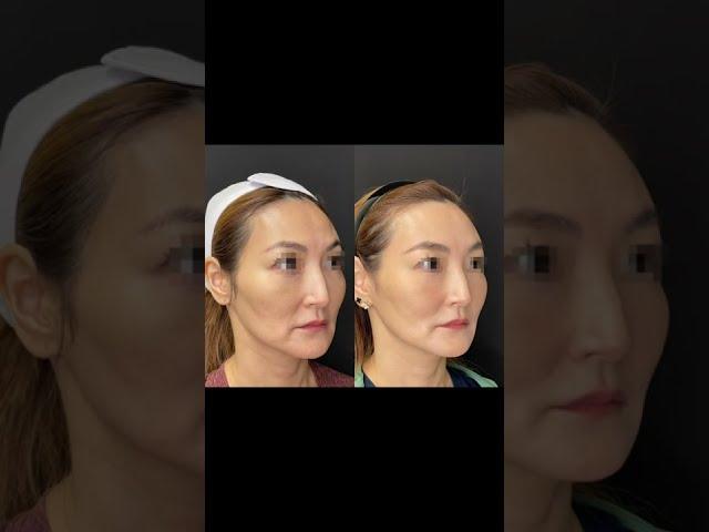 PDO Thread Invasive Nonsurgical Thread Face Lift Treatment - Ageless MD