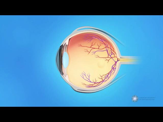 What causes a retinal tear or detachment?