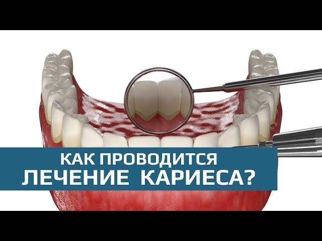 Лечение кариеса: этапы лечения кариеса