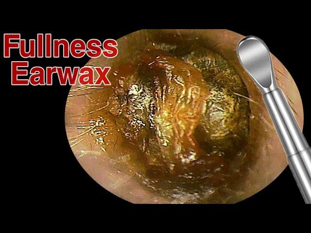 BIGGEST Ear Wax, Difficult Removal - EP3 | Doctor Anh