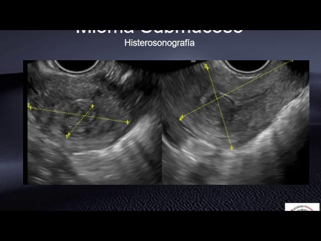Mioma submucoso