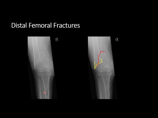 Knee  Part 1