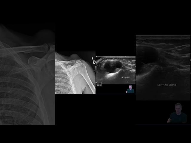 It Might be a Tumor  Geyser Sign #meded #orthopedicsurgeon #emergencymedicine #radiology #medschool