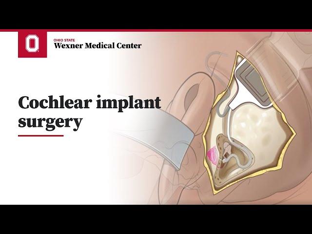 Cochlear implant surgery | Ohio State Medical Center