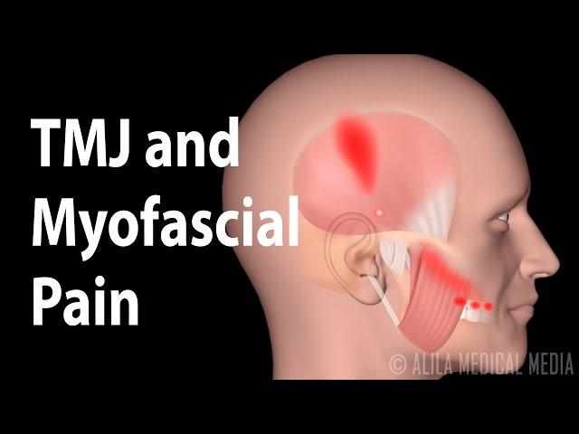 TMJ and  Myofascial Pain Syndrome, Animation.