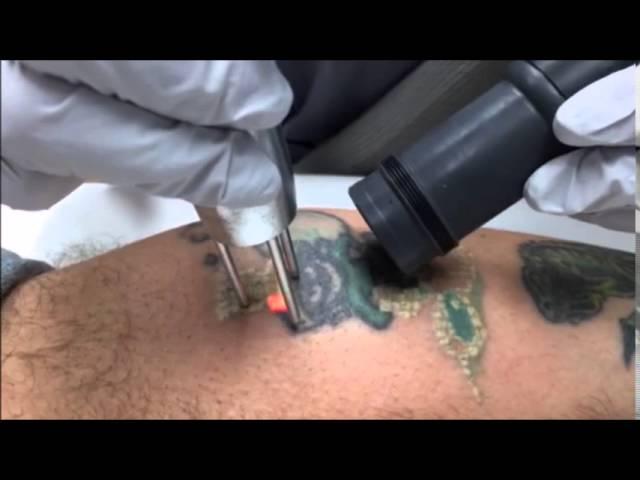 Laser Tattoo Removal,First Treatment, Skin Deep, Burke VA, Fairfax County VA, Northern VA